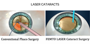 LASER CATARACTS