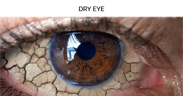 DRY EYE